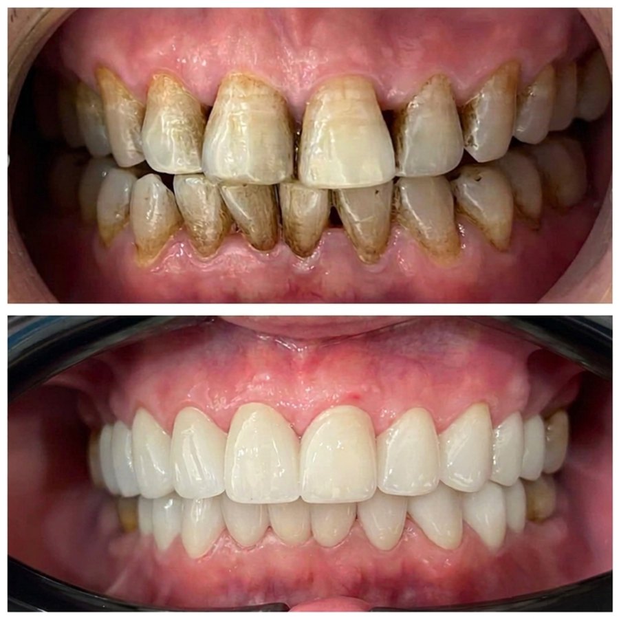 Before and after full-arch porcelain crowns on teeth with heavy staining and tartar