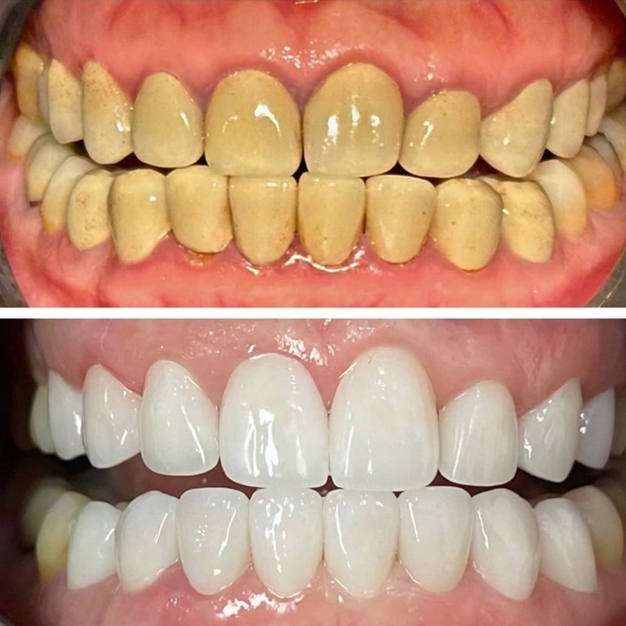 Before and after porcelain veneers treating long-term discolouration