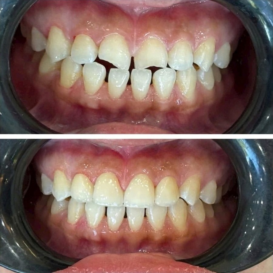 Before and after restoration of chipped and uneven teeth with porcelain