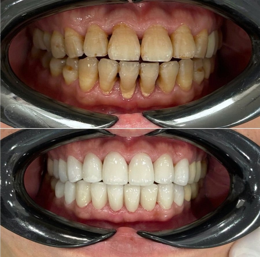 Before and after porcelain crowns on the upper and lower arches
