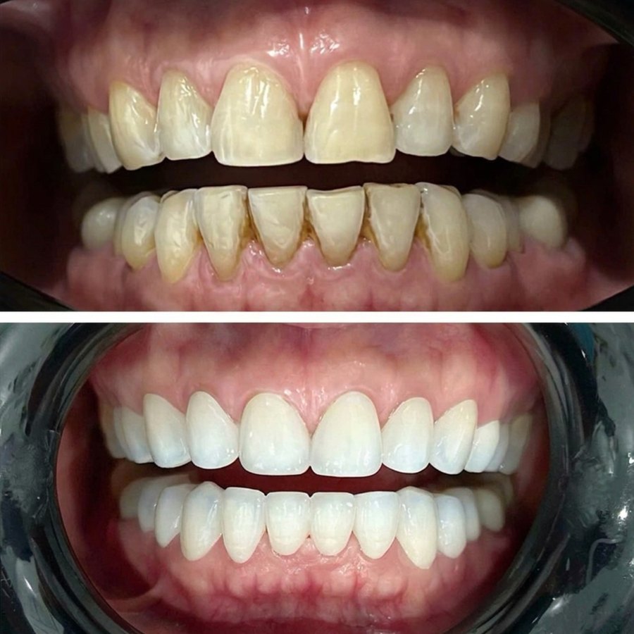 Before and after porcelain veneers on worn, uneven teeth