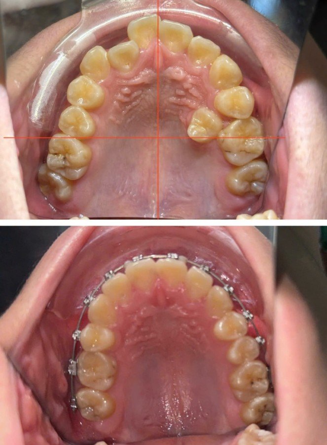 Orthodontic treatment, occlusal view of a crowded upper arch — fixed braces fitted