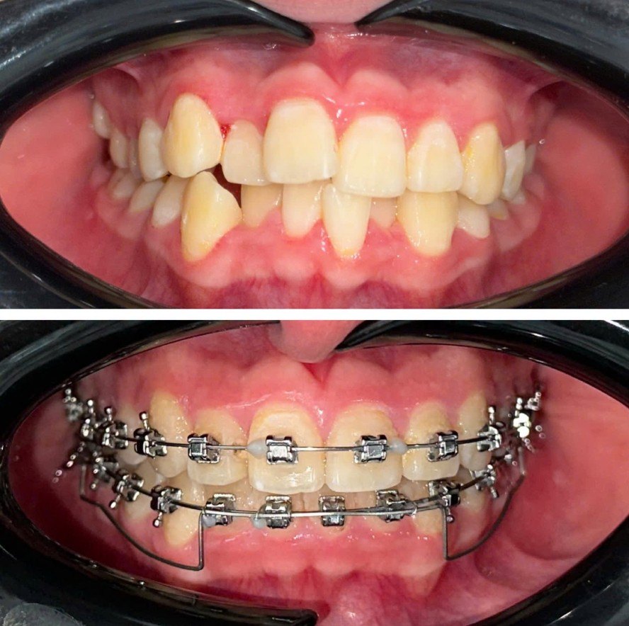 Orthodontic treatment for crowding — fixed braces fitted