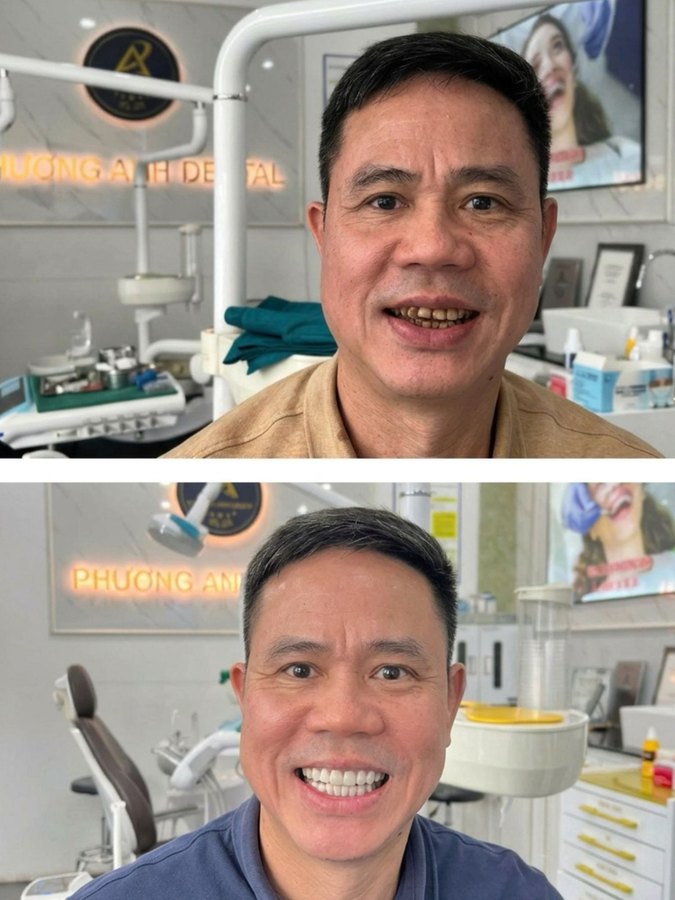 Before and after full smile restoration — male patient