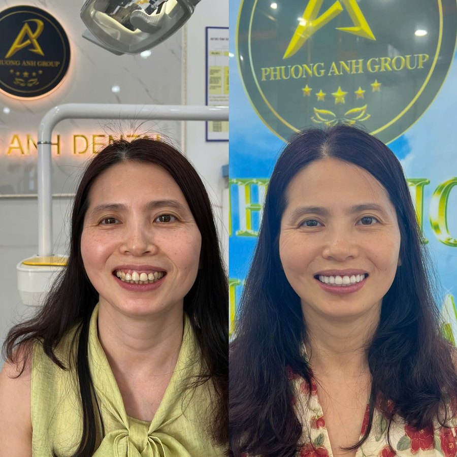 Before and after full smile restoration — female patient, shown side by side