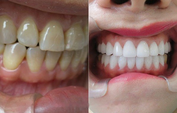 Before and after porcelain veneers, shown side by side