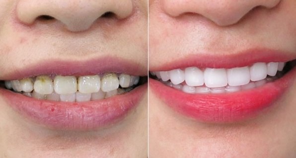 Before and after full smile restoration on stained and uneven upper teeth, shown side by side