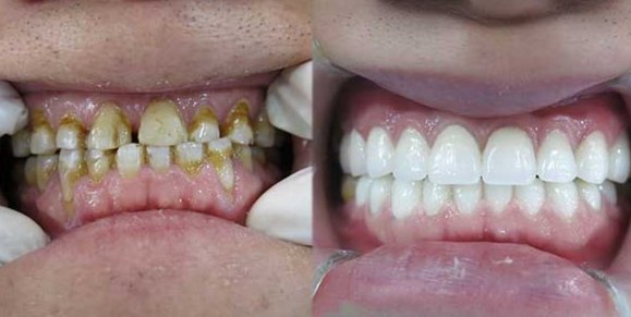 Before and after full-arch restoration on teeth with heavy staining and tartar, shown side by side