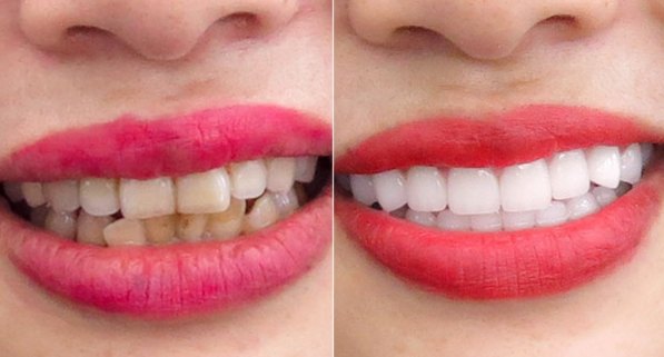 Before and after full smile restoration treating long-term yellowing, shown side by side